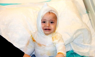 Üzerine kaynar süt dökülen 1 yaşındaki çocuk feci şekilde yandı