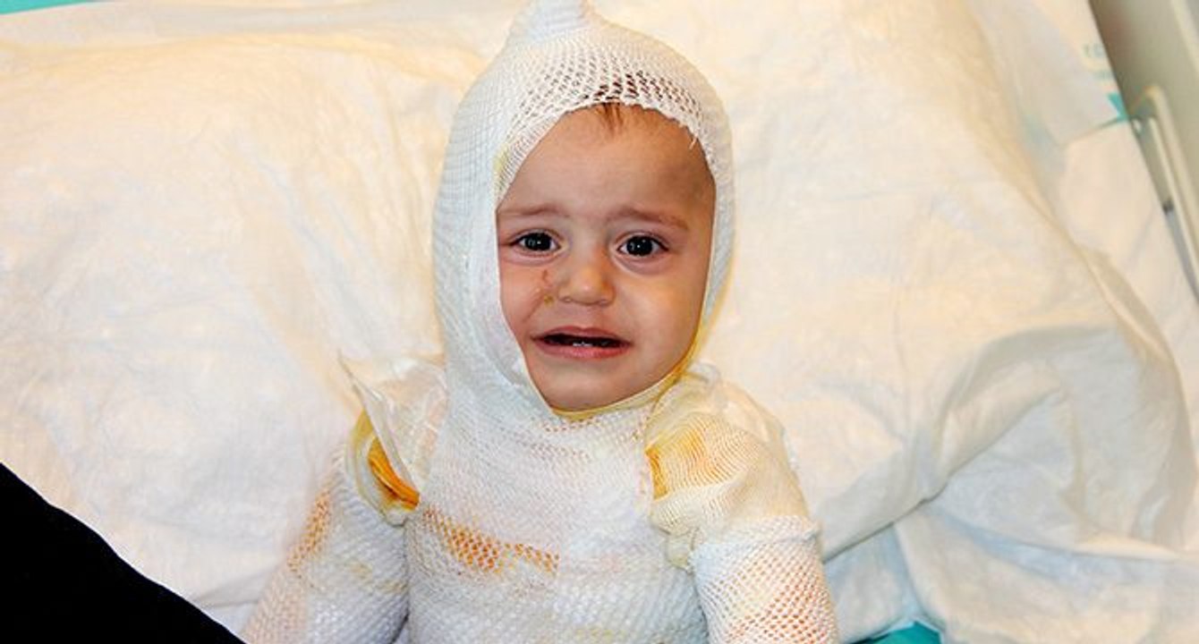 Üzerine kaynar süt dökülen çocuk feci şekilde yandı