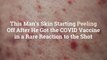 This Man's Skin Starting Peeling Off After He Got the COVID Vaccine in a Rare Reaction to