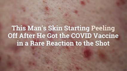 Download Video: This Man's Skin Starting Peeling Off After He Got the COVID Vaccine in a Rare Reaction to