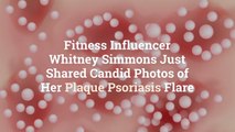 Fitness Influencer Whitney Simmons Just Shared Candid Photos of Her Plaque Psoriasis Flare