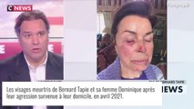 Agression de Bernard Tapie et sa femme Dominique : photos de leurs visages tuméfiés