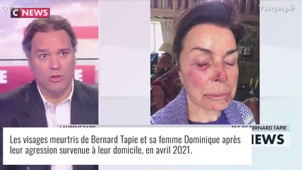 Agression de Bernard Tapie et sa femme Dominique : photos de leurs visages tuméfiés