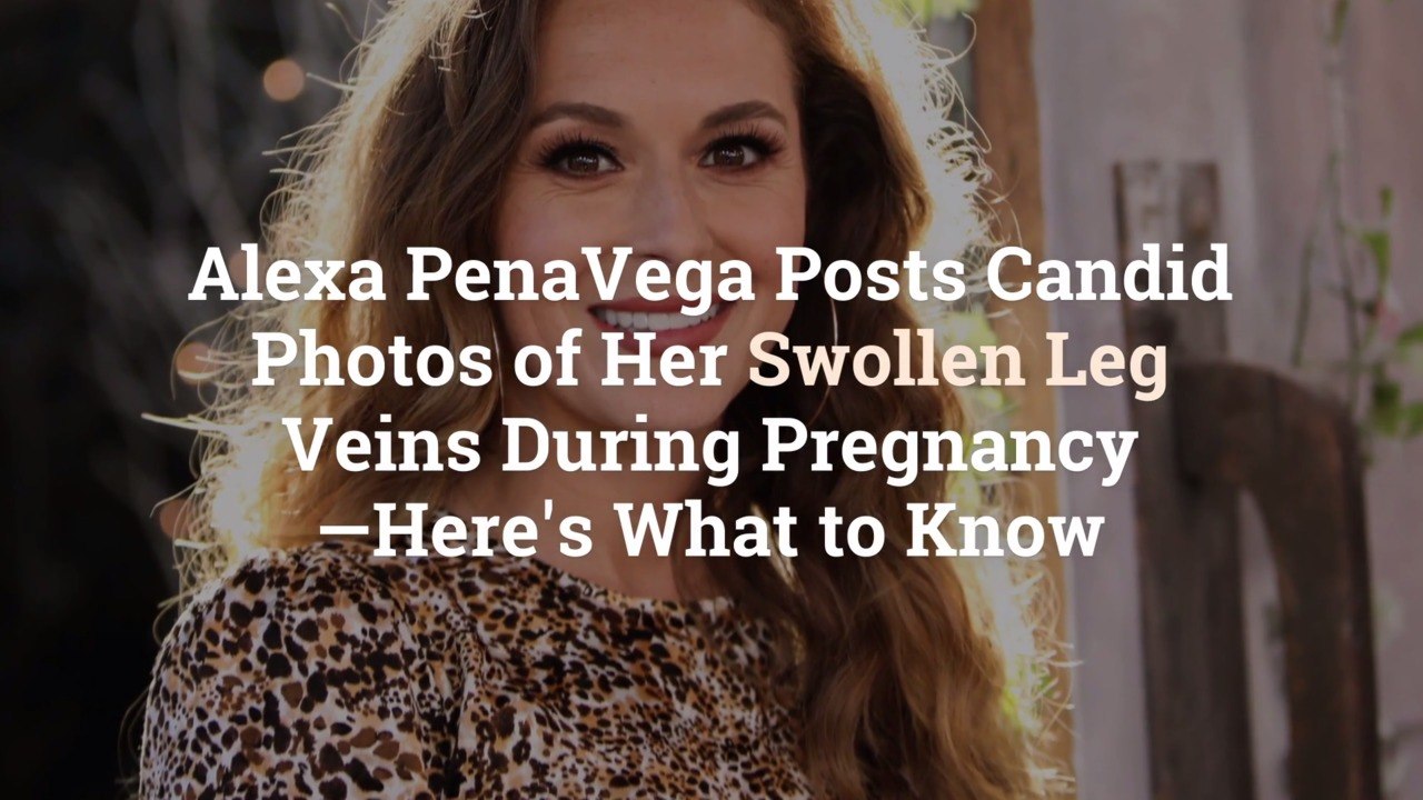Alexa PenaVega Posts Candid Photos of Her Swollen Leg Veins During Pregnancy—Here’s What t
