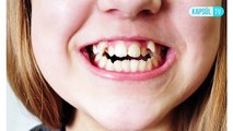 Süt dişlerini çektirmek zararlı mıdır? Ne zaman dökülür?