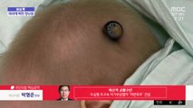 [이슈톡] 머리에 장난감 박힌 러시아 아기