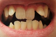 Dentes tortos prejudicam a saúde? Odontologo Felipe Vieiira responde