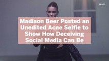 Madison Beer Posted an Unedited Acne Selfie to Show How Deceiving Social Media Can Be