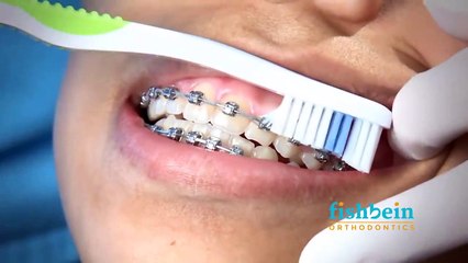 Orthodontic Home Care Instructions | Braces | Brushing