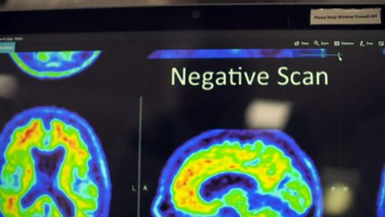 Profound loss of pleasure related to early-onset dementia
