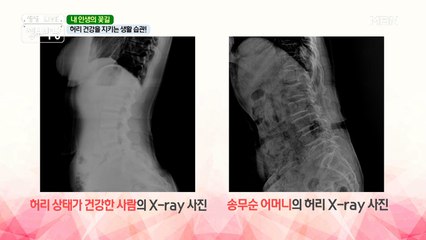 척추관 협착증 발병 원인은??  (･̆⍛･̆)