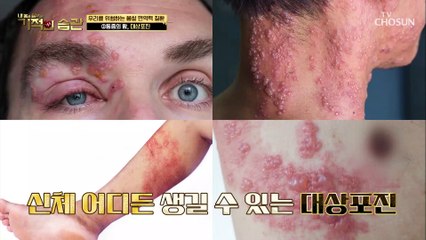 봄철 면역력의 중요성! 다양한 질환으로 이어지는 각종 염증 TV CHOSUN 210413 방송