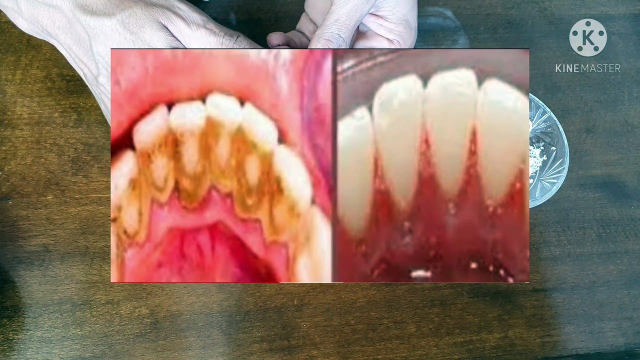 Teeth whitening in just 2 minutes - how to whiten teeth at home? 100% effective