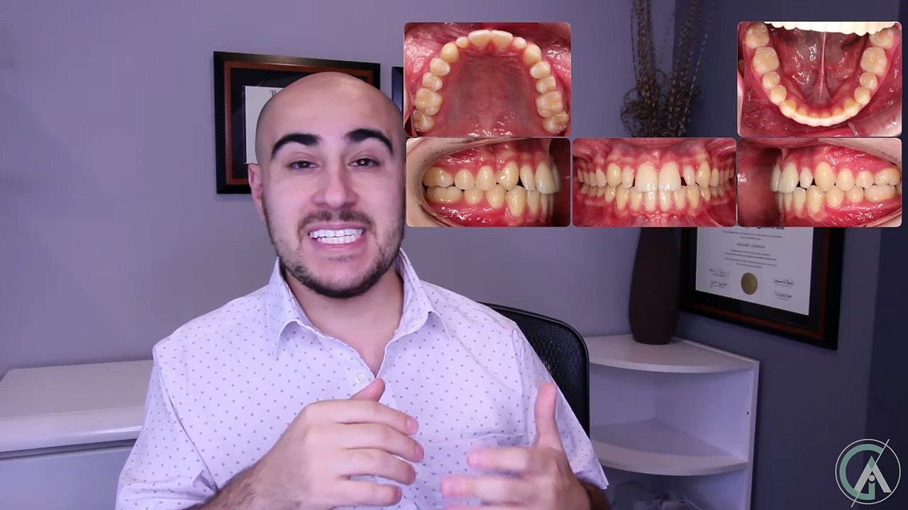 Dental Veneers After Braces Or Invisalign video Dailymotion