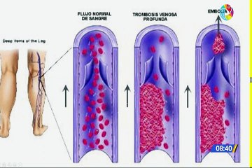 Trombosis ¿que es y como se trata?