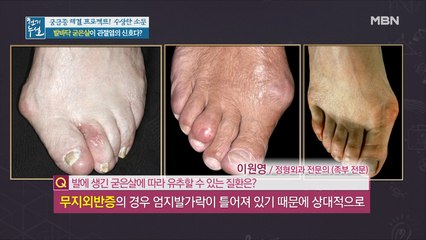 발바닥 굳은살 위치로 여러가지 질환을 유추할 수 있다?