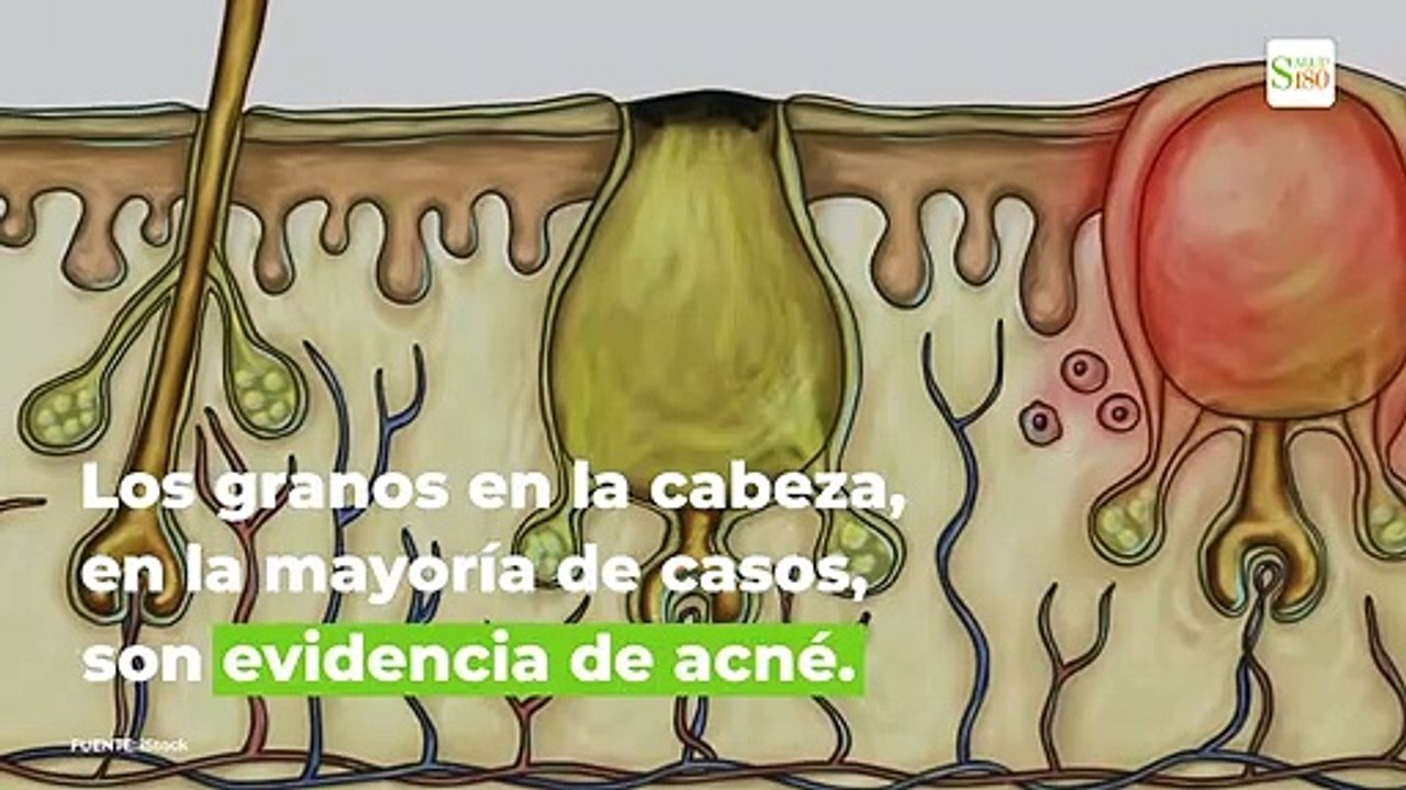 Por que salen granos en la cabeza | Salud 180