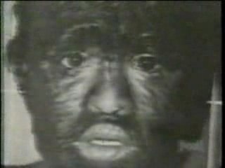 Guinness World Records-Werewolf Syndrome