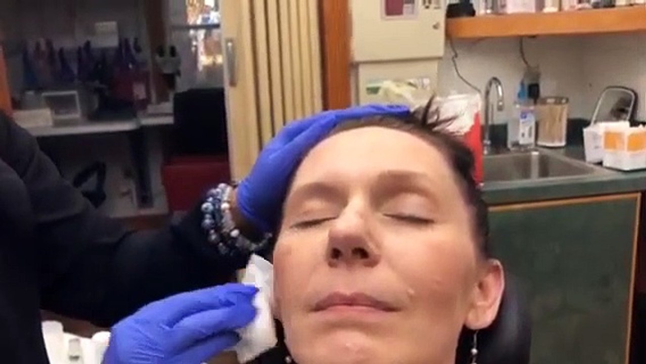 Chemical Peel 1 | Progress And Update On Hyperpigmentation |  Chemical Peel Before & After