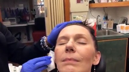 Chemical Peel 1 | Progress And Update On Hyperpigmentation |  Chemical Peel Before & After