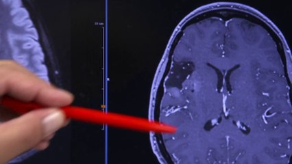 Santé - La chirurgie éveillée du cerveau