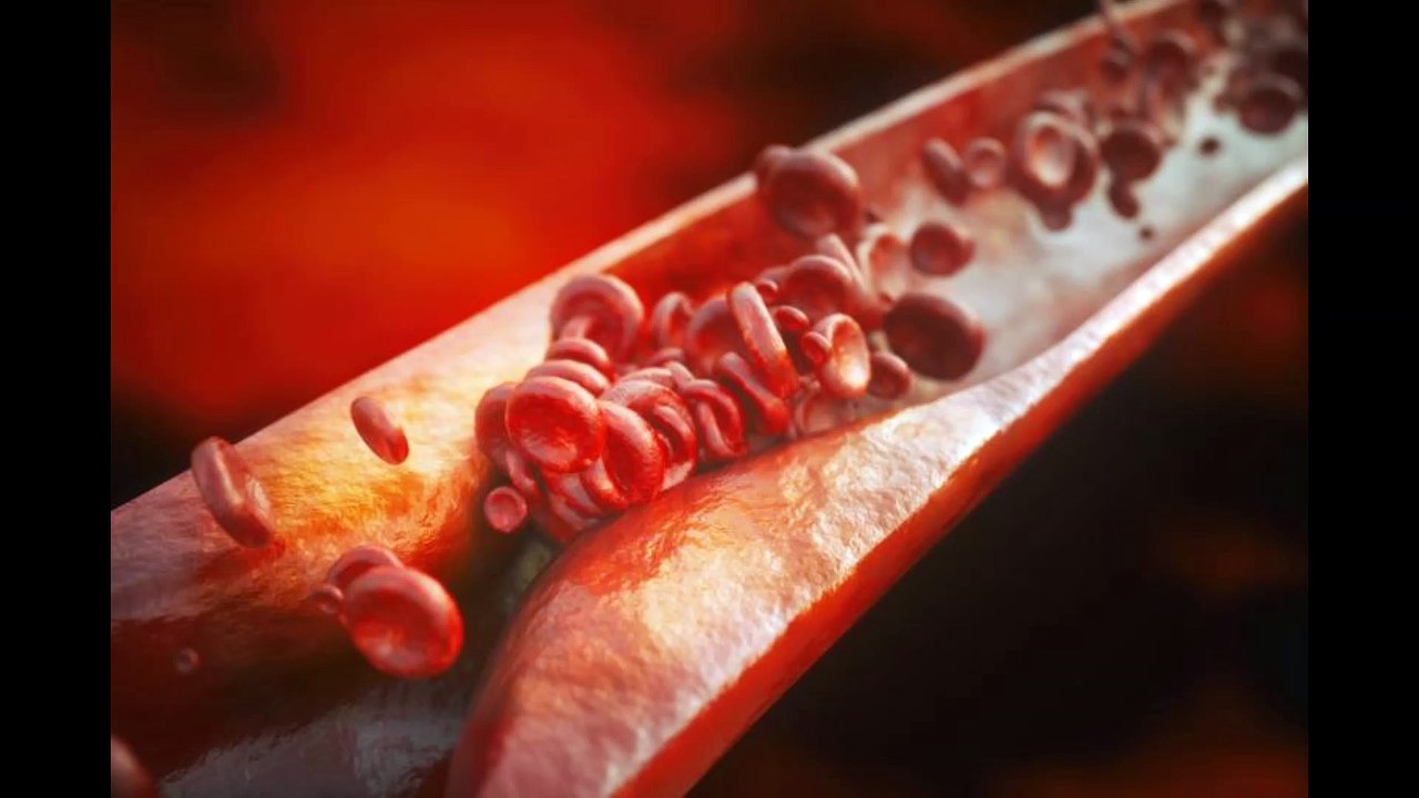 3/ 62Hz Arteriosclerosis