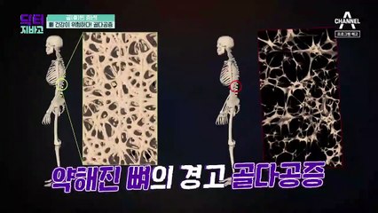 [예고] 약해진 뼈의 경고! 골다공증