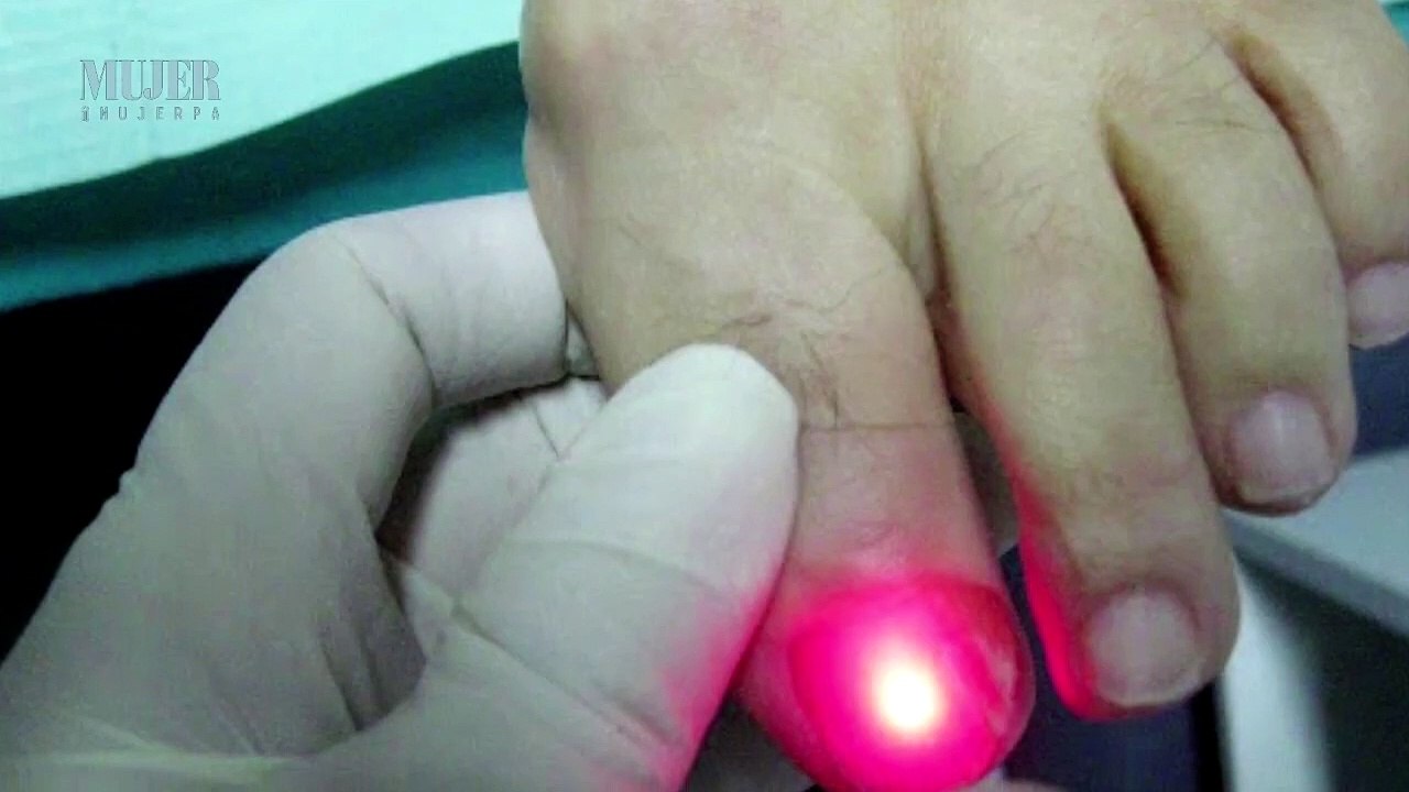 Láser para tratar los hongos en las uñas | Mu...