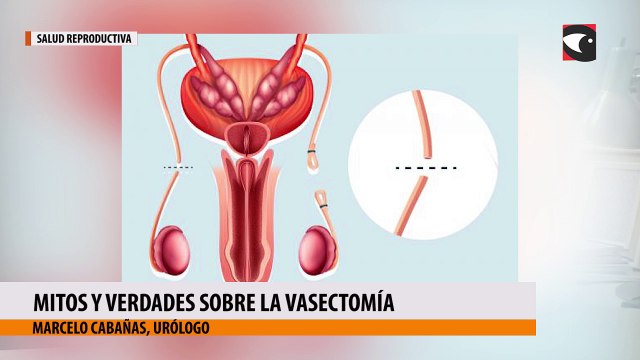 Mitos y verdades sobre la vasectomía