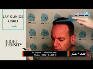 اليكم التقنيات الحديثة الأكثر فعالية في زراعة الشعر