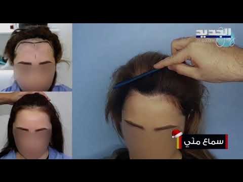 حالات الصلع لدى النساء والرجال...الأسباب والحلول مع الإختصاصي أبراهيم جباعي