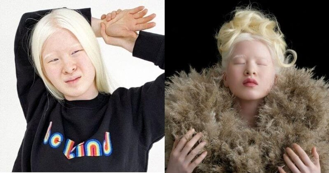 Abandonnée à sa naissance en raison de son albinisme, elle est aujourd'hui mannequin pour Vogue