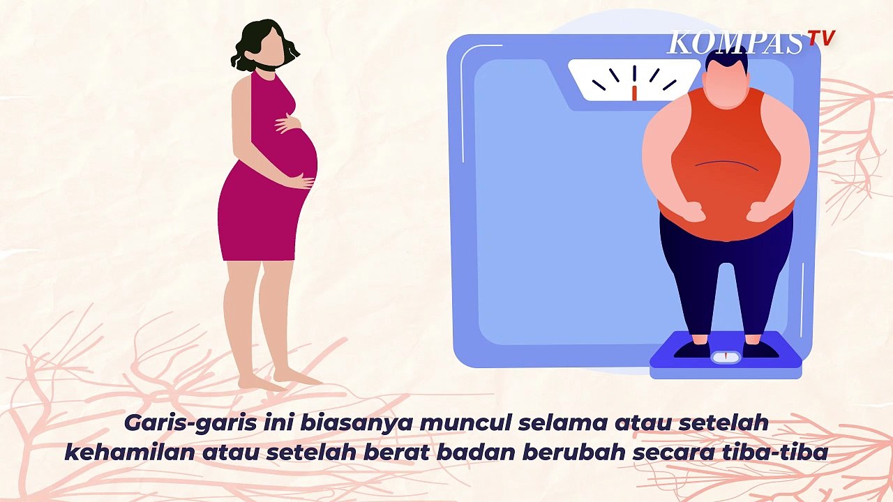 Apa yang Menyebabkan Stretch Mark pada Kulit?