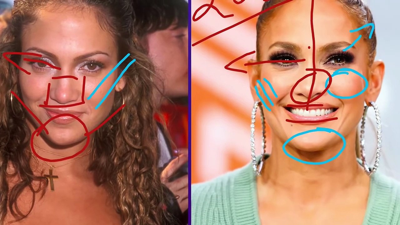 J Lo'S Plastic Surgery And What We Can Learn - Non Surgical Facelift