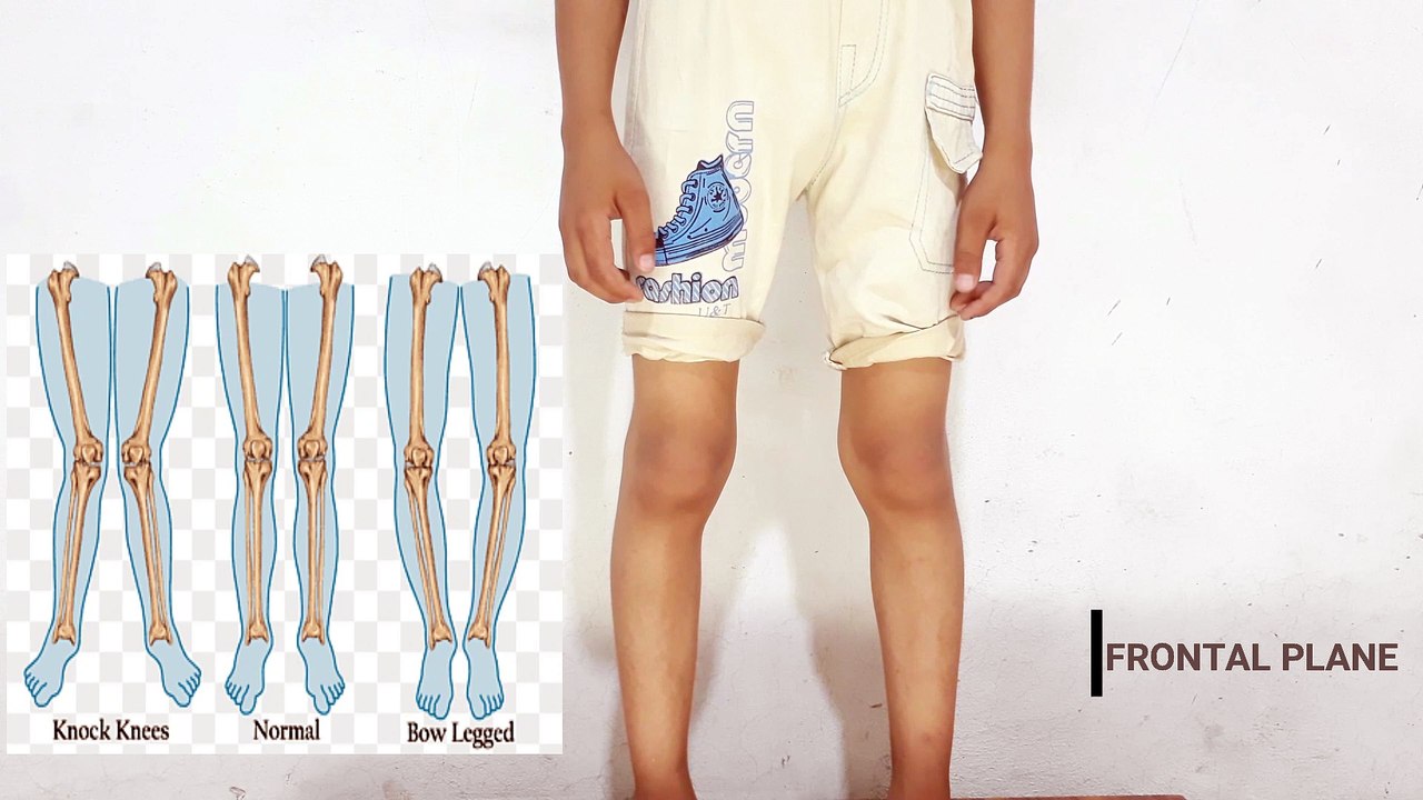 OBSERVATION & POSTURAL ANALYSIS |URDU & HINDI| A.M Physios