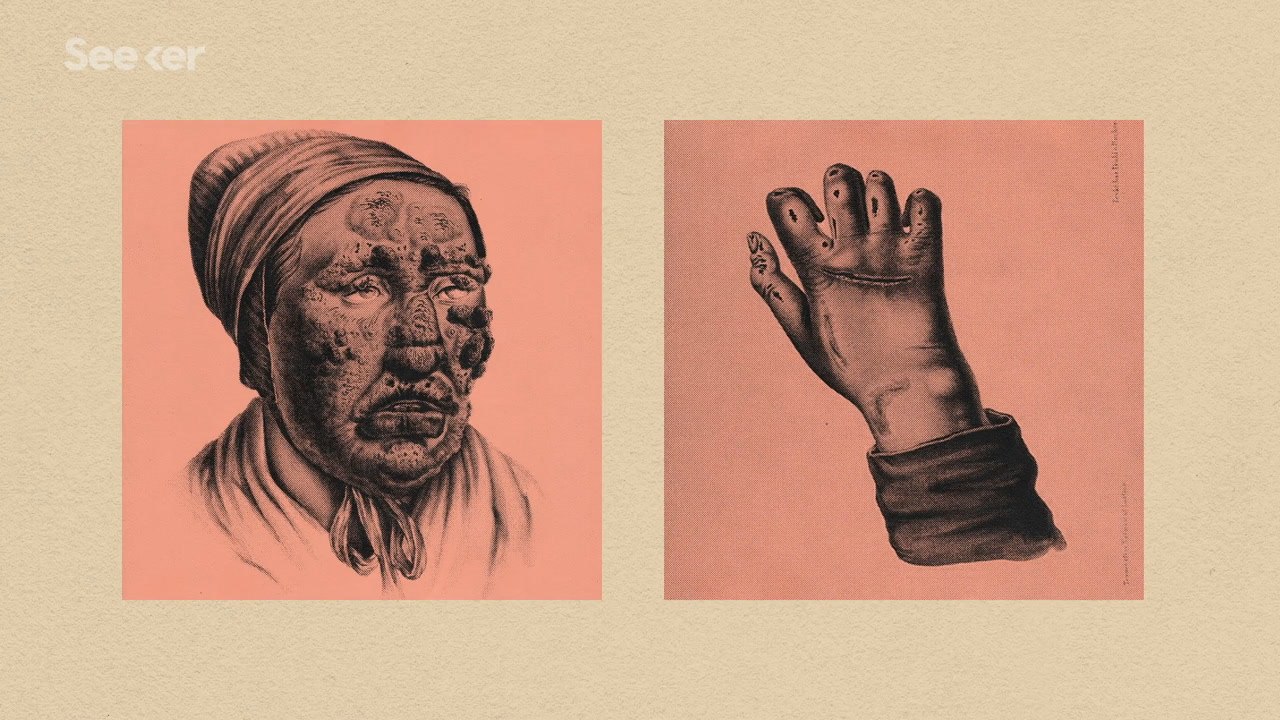 How Does Leprosy Damage The Human Body?