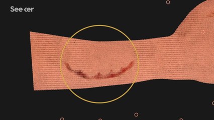 What Happens When a Human Gets Rabies?