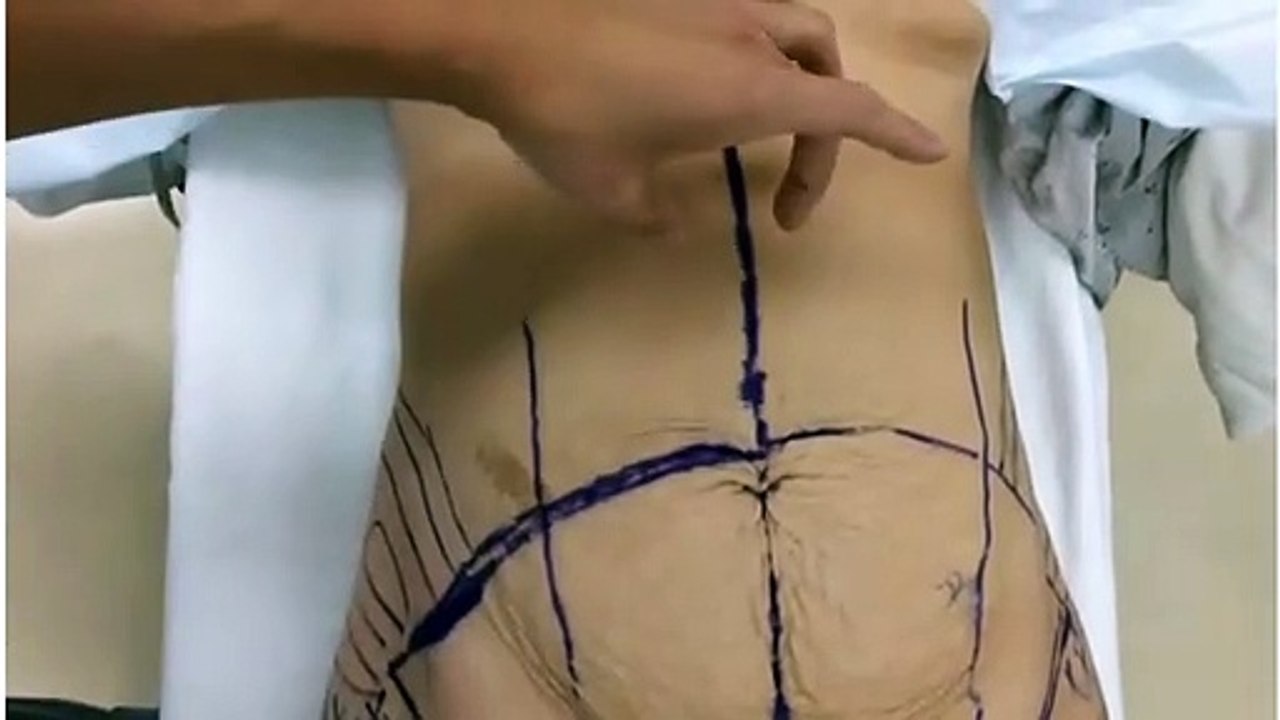 Tummy Tuck And Hernia Repair - Before And After!