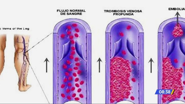 Trombosis causas y población más propensa
