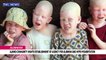 Albino community wants establishment of agency for albinism and Hypo-Pigmentation