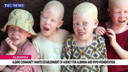 Albino community wants establishment of agency for albinism and Hypo-Pigmentation