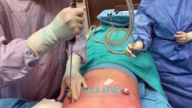 JİNEKOMASTİ AMELİYATI VE SONRASINDA OLANLAR_! | Op. Dr. Leyla Arvas