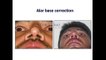 Nose (Rhinoplasty) Surgery Before And After Images - Real Nose Job Photos - Dr Y V Rao Clinics