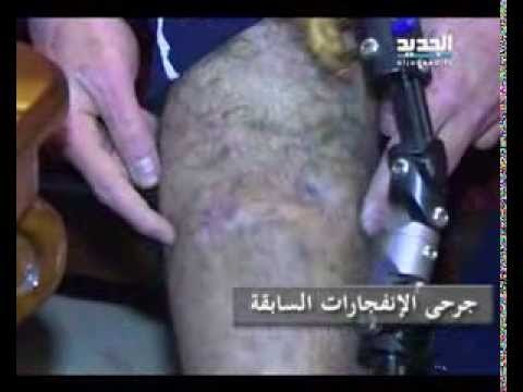 جرحى الإنفجارات - ليال بو موسى