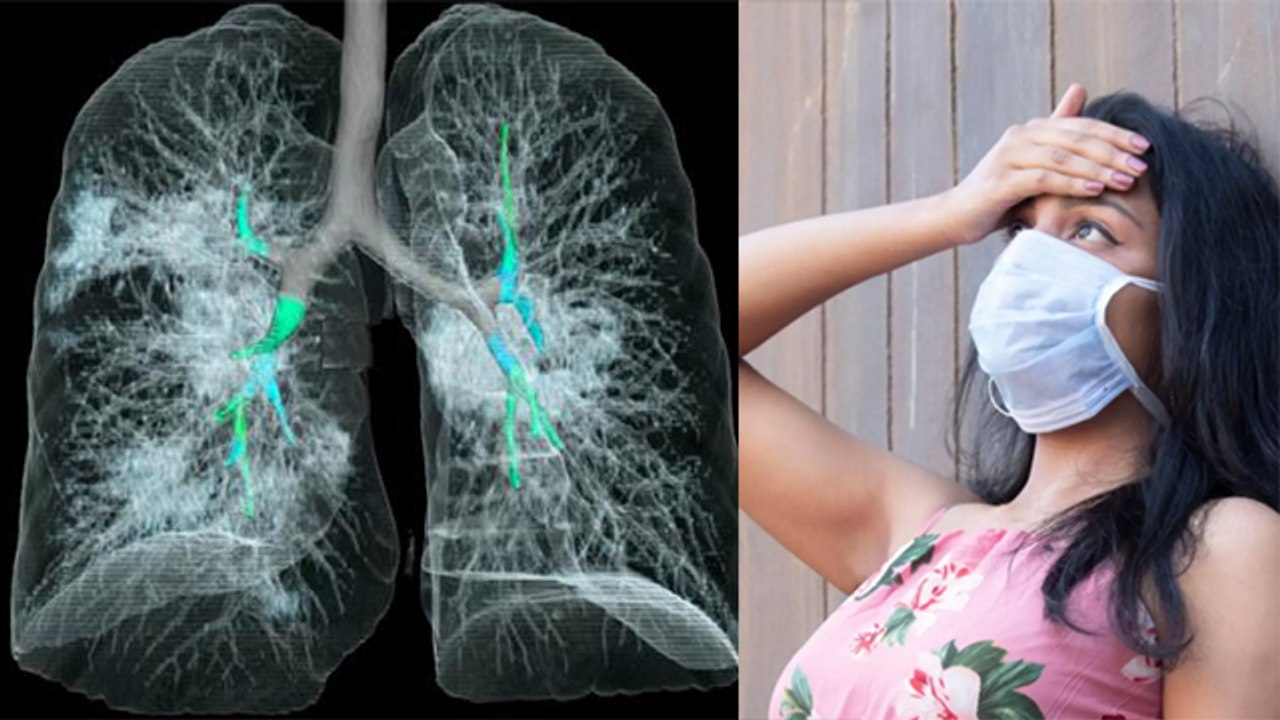 Corona Virus तीन दिन में कर रहा बड़ा हमला, LUNGS का हो रहा ये हाल | Boldsky