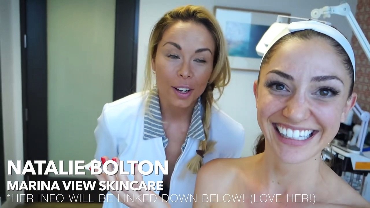 I Got A Chemical Peel! Perfect Peel Review, Daily Check In + Before/After!