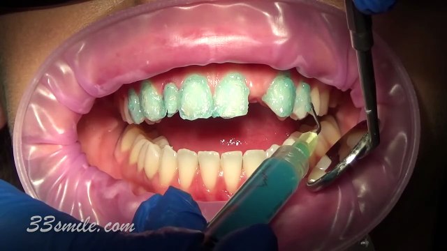 Alex Gets A Brazilian Wax For The First Time | On The Rag: Body Hair