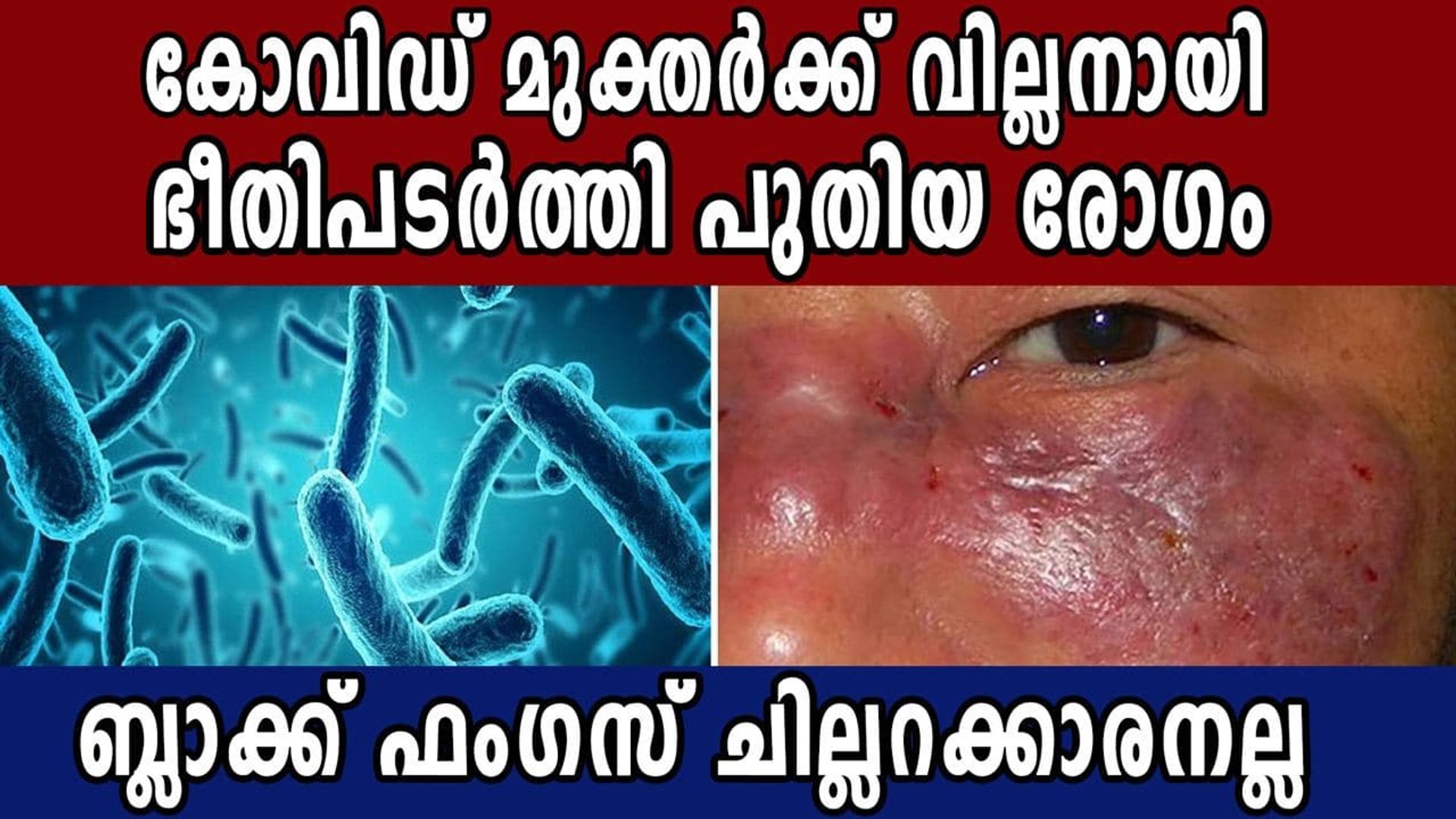 Black Fungus In Covid 19 Patients What Is The Disease Treatment Oneindia Malayalam Video Dailymotion