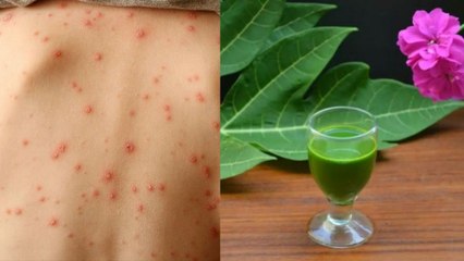 Coronavirus Patient के Skin पर हो गए है Red Rashes तो तुरंत लगाएं ये एक चीज | Boldsky
