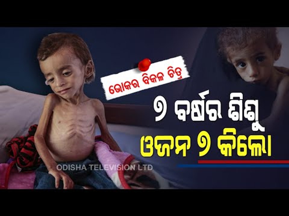 Special Story | Malnourished Yemeni Boy Weighs 7 Kilograms, Malnutrition Haunts Yemen